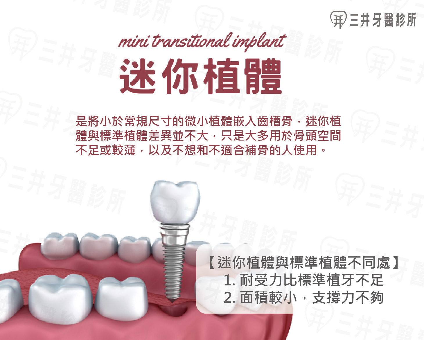 什麼是迷你植體？植牙關鍵在於骨頭條件