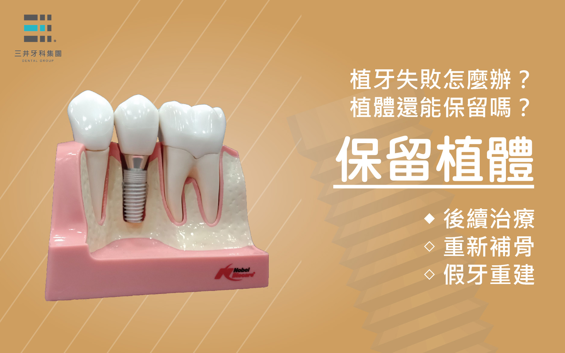 植牙失敗怎麼辦!?植體還能保留嗎？