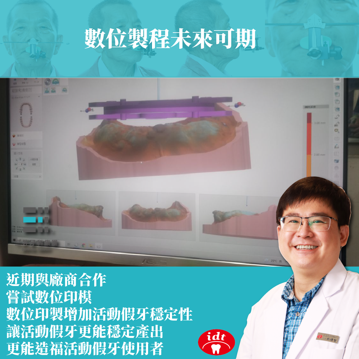 BPS全口活動假牙(義齒)數位製程未來可期