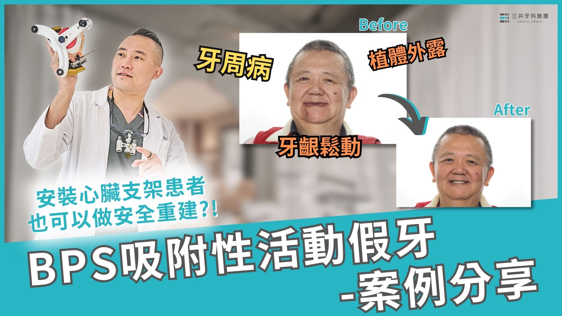 BPS吸附性活動假牙 配戴體驗分享 【三井牙科集團】重建自信笑容 展現飲食樂趣